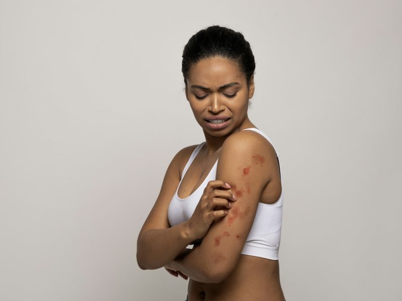 Stressed black woman scratching red spots on her skin